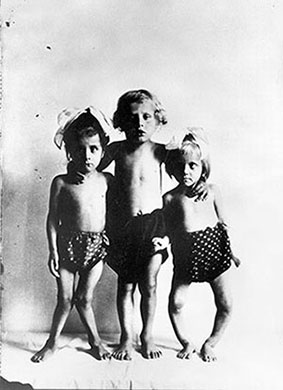 Three children with rickets