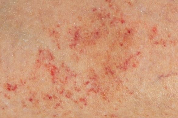 Red rash on Caucasian skin